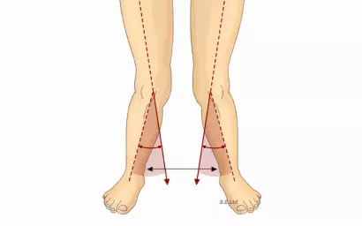 ¡Puede ser Genu Valgo si tienen las rodillas en X!